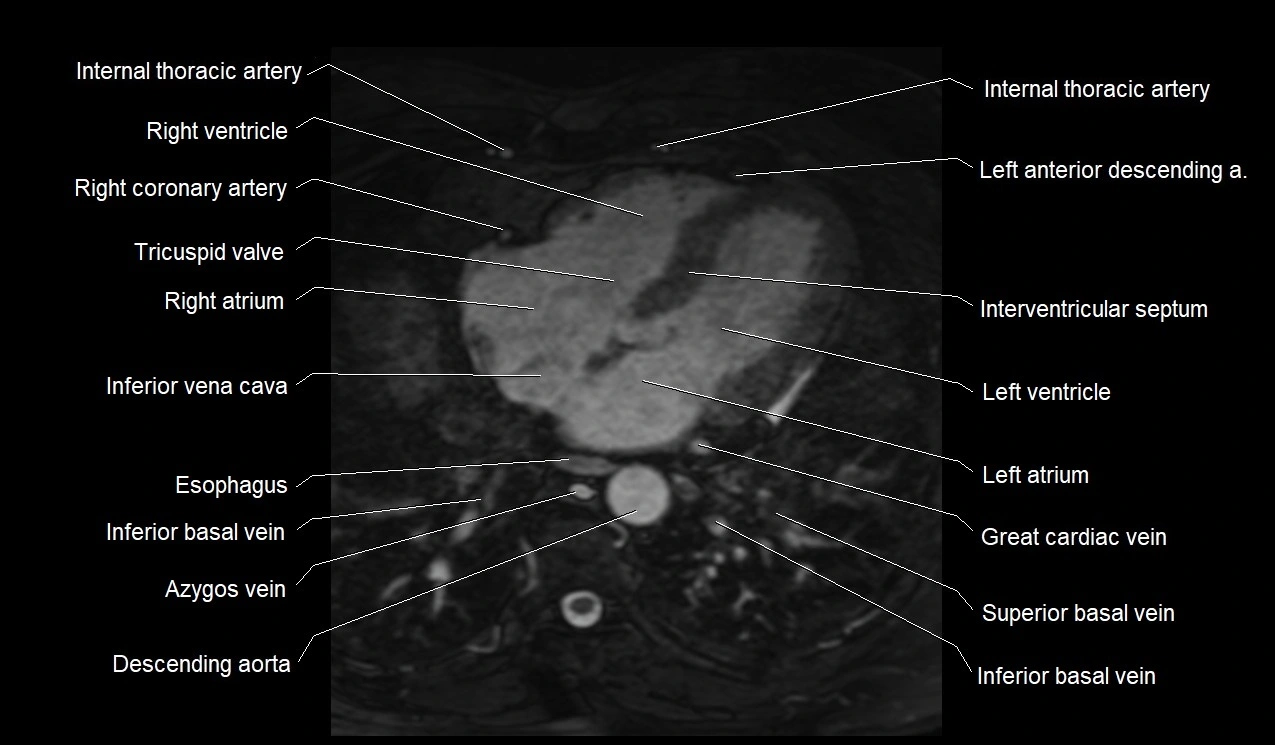 MRI heart coronary arteries and coronary veins anatomy axial image 30.webp